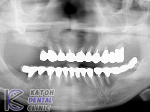 重症の歯周病症例