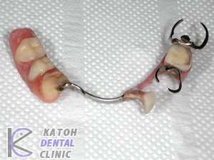 臼歯部インプラント(2002年治療終了）