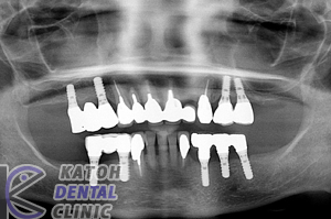 臼歯部インプラント