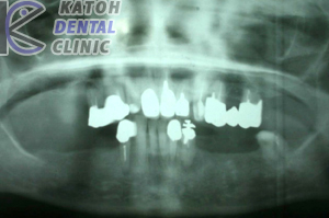 臼歯部インプラント(2000年ごろ）