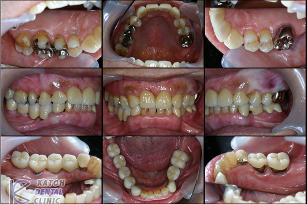 歯部インプラントと前歯部審美修復