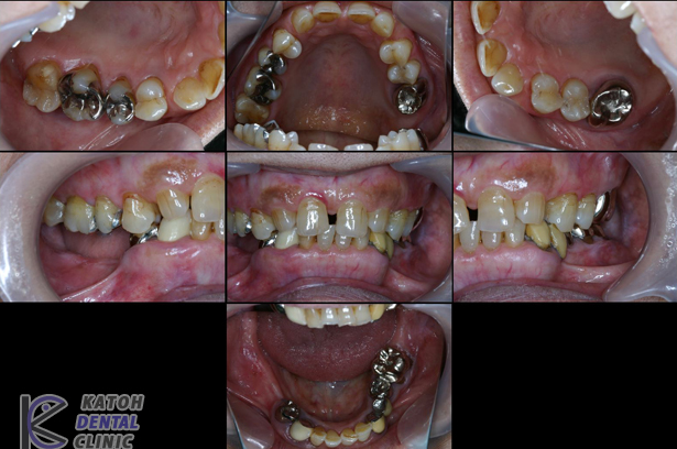 歯部インプラントと前歯部審美修復