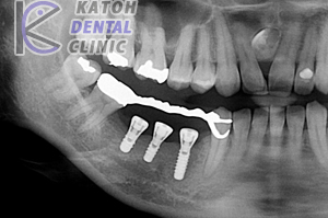 小臼歯部インプラント修復