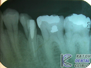 症例25　臼歯部インプラント審美修復 (１９９３年治療終了）
