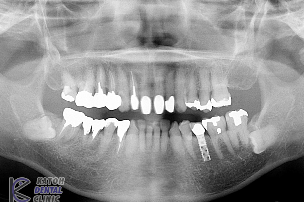 臼歯部インプラント審美修復 